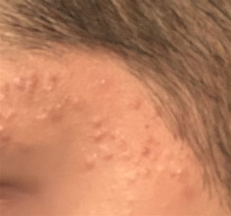 Can anyone help, small spots side of face – General acne discussion ...