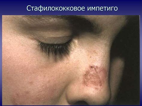 Пиодермии. Стрептодермия - презентация онлайн