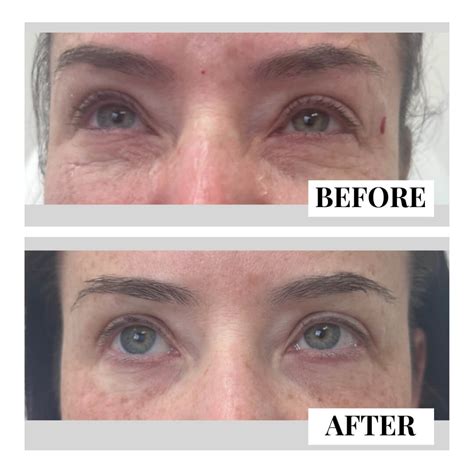 Under Eye Hollows / Dark Circles - New Medical Spa