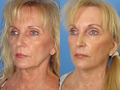 Lower Facelift Guide: What Are They, Cost, & Recovery