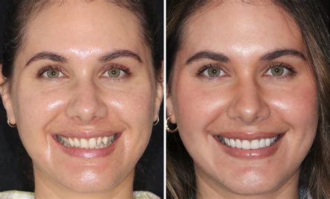 Antes E Depois Dentes De Porcelana - Dente de Porcelana: O que você precisa saber?
