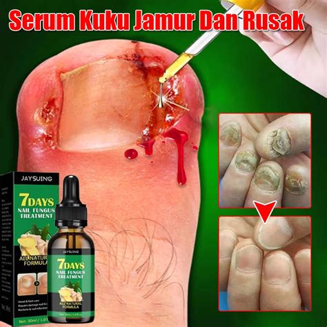 jual obat cantengan obt kuku jamur  rusak original obat jamur kuku
