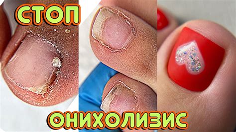 Огромная подногтевая мозоль 😱 СТОП онихолизис! Аппаратный педикюр - YouTube