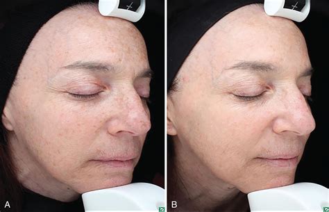 Laser Treatment of Pigmented Lesions and Tattoos - Clinical Tree