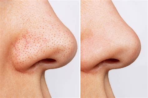 Will Unbelievable Blackhead Removal 2024 Work For You? Find Out Now! Image 12