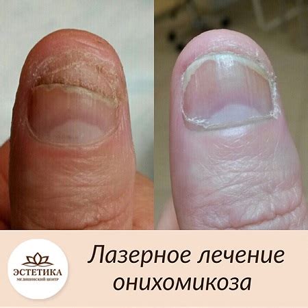 Лазерное лечение онихомикоза, или грибка ногтей, цена