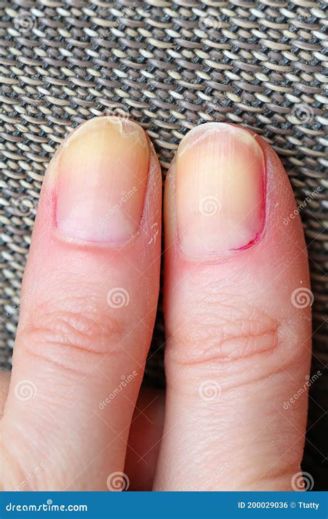 Untidy cracked fingernails stock photo. Image of care - 200029036