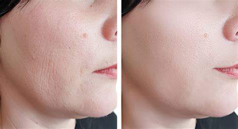 laser wrinkles rsskinandpainclinic