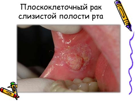 Опухоли, общие положения. Лекция по патологической анатомии ...