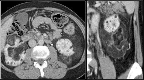 Ангиомиолипома почки — 24Radiology.ru