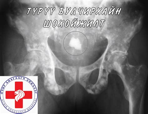 Түрүү булчирхайны... - ОЧИР Анагаагч Эрэгтэйчүүдийн Эмнэлэг