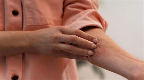 Can Itchy Skin Be A Sign Of Cancer? Here's What Doctor Has To Say ...