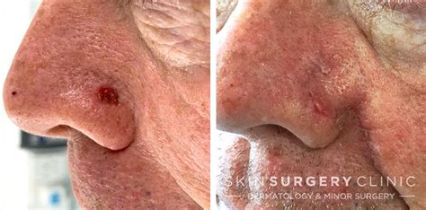 Private Skin Cancer Treatment - Skin Surgery Clinic