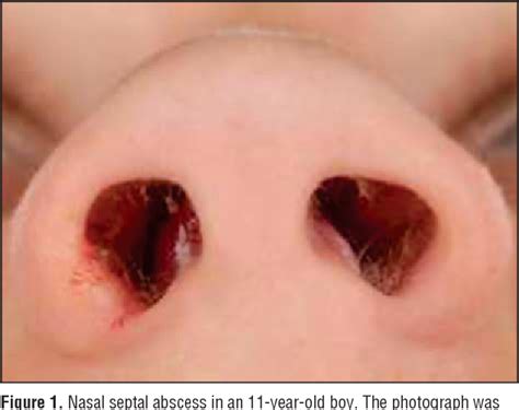 Figure 1 from Nasal septal abscess in children: reconstruction with ...