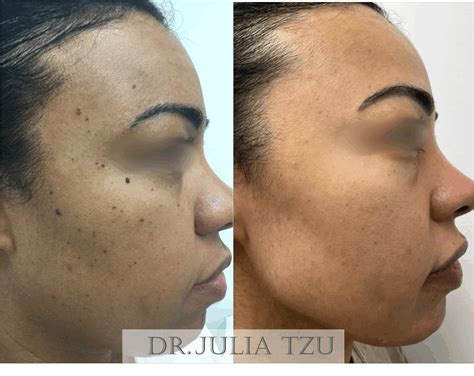 DPN Removal NYC | 150+ 5-Star Reviews