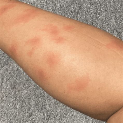 Mosquito Bites Vs Bed Bug Bites: Pictures Of Bite Marks