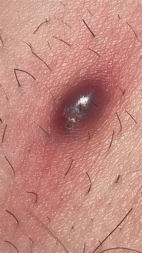 Ingrown hair cyst? Do I need to go see a doctor? What do I do? : r/skin