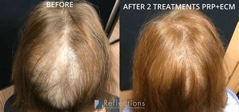 39+ Hers Hair Regrowth Treatment - MuirNicolas