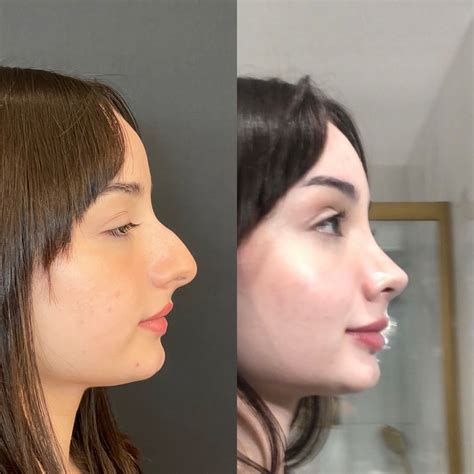 Rhinoplasty Surgery in İzmir! 🇹🇷 : Before and After Pictures 🤩 💌