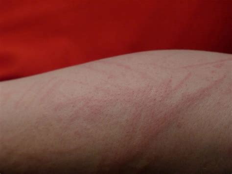 how to cure bed bug bite 8