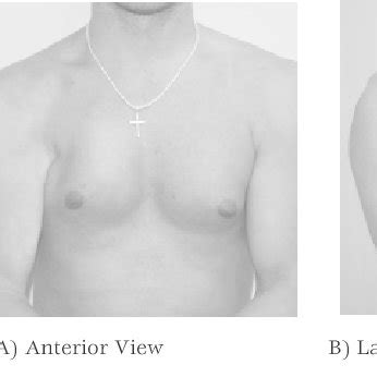 (PDF) Pectoralis Major Tendon Repair Post Surgical Rehabilitation