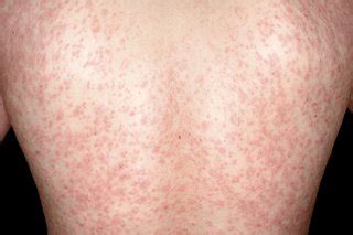 Pityriasis rosea - EM Doctors