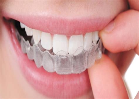 orthodontic treatment  kolkata braces aligners radix