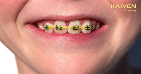 nieng  rang cua  duoc khong gia bao nhieu tien nha khoa quoc te