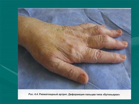 Суставной синдром - презентация онлайн