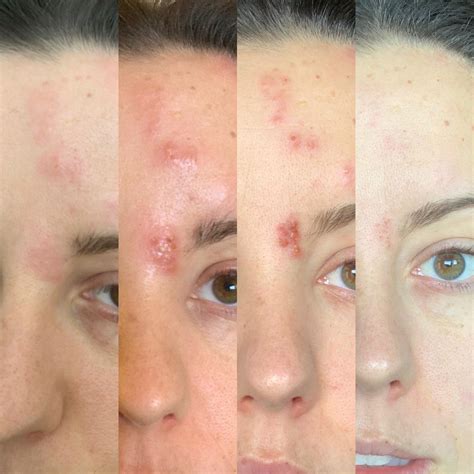 weekly shingles progress rshingles