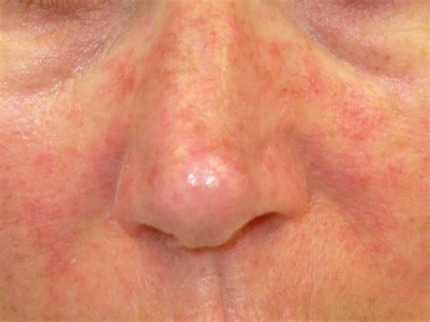 Viral Rash On Face