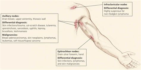 Axillary lymphadenopathy causes, diagnosis & treatment