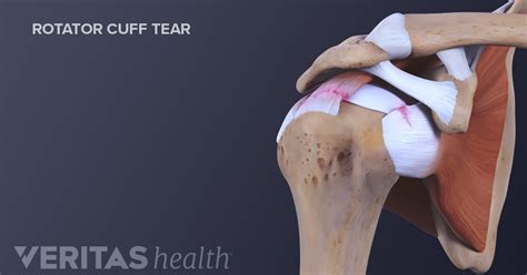 Rotator Cuff Injuries: Symptoms