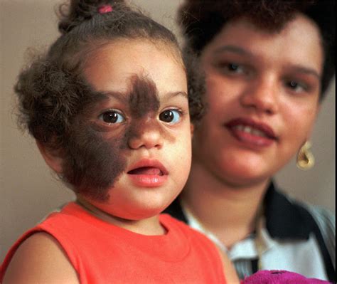 16 CHILDREN DEVELOP WEREWOLF SYNDROME AFTER TAKING CONTAMINATED MEDICATION.