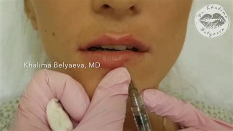 Увеличение губ препаратами ГК 💉 Губки - ниточки ИИИИИ 👌🏽💋 - YouTube