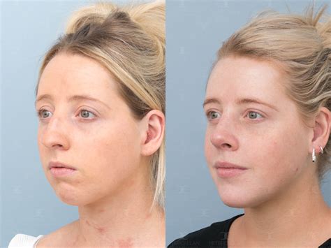 Brandybilly: Before And After Photos That Will Amaze You! Image 6