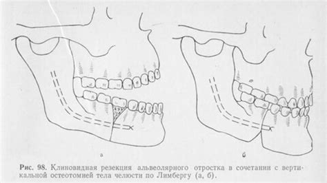 Перелом альвеолярного отростка - причины, лечение