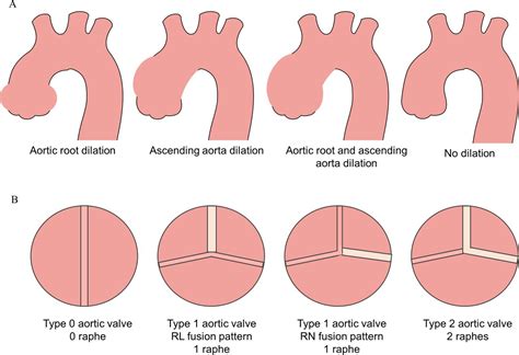 Aortic Root Dilation