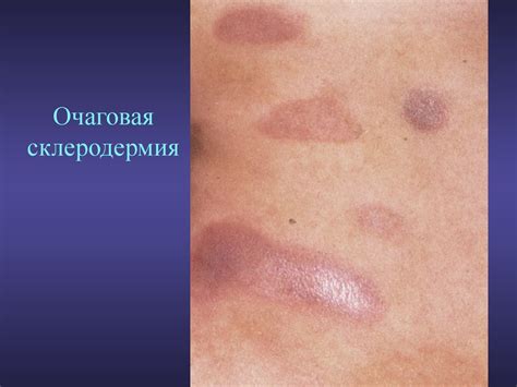 Системные заболевания кожи - презентация онлайн