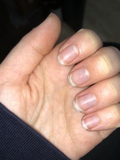 Does anyone know why the white parts of my nails are transparent in