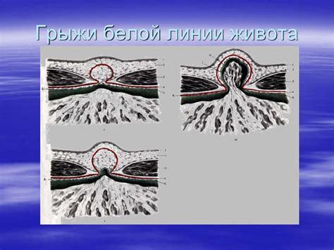 Лечение грыж - презентация онлайн