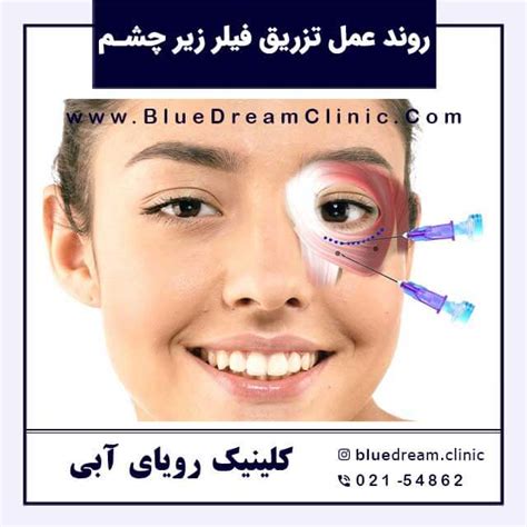 فیلر زیر چشم؛ انواع، مزایا، عوارض و هر آنچه که باید بدانید