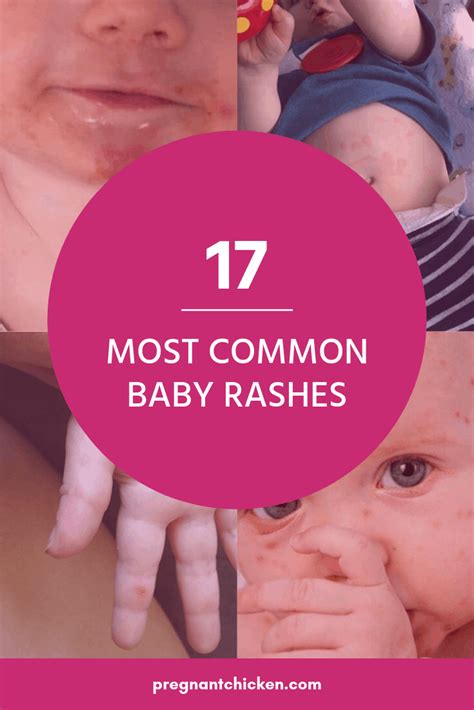 Baby rashes symptoms causes treatment – Artofit
