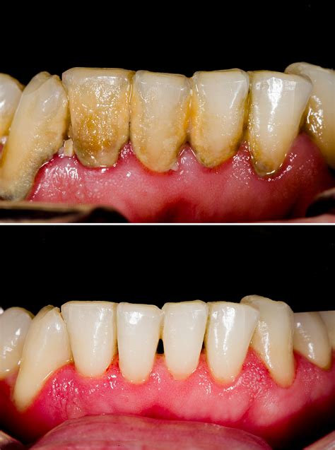 periodontal disease gum disease tuxedo dental group