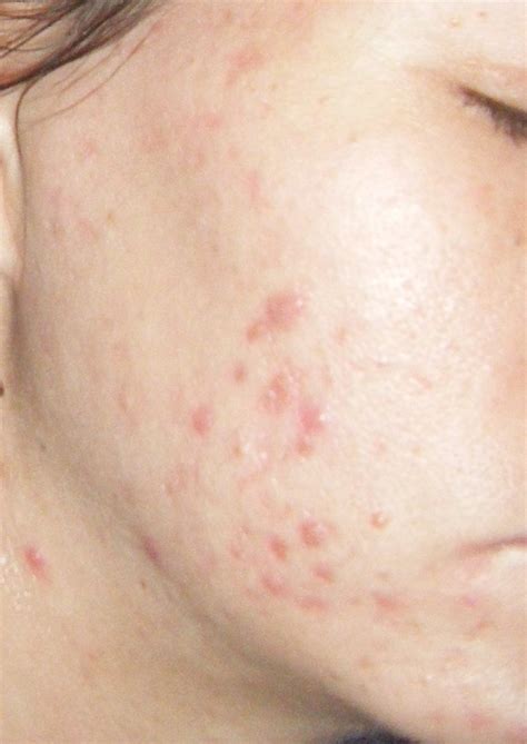 Swollen Lymph Nodes Face | Images and Photos finder