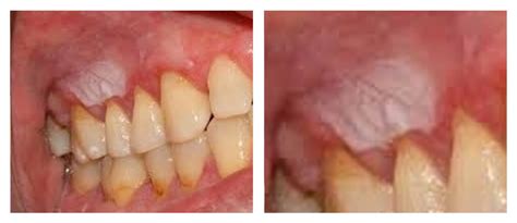 Machucado Branco Na Boca - LESÃO BRANCA BOCA - Clínica Dentária Jardim dos Arcos