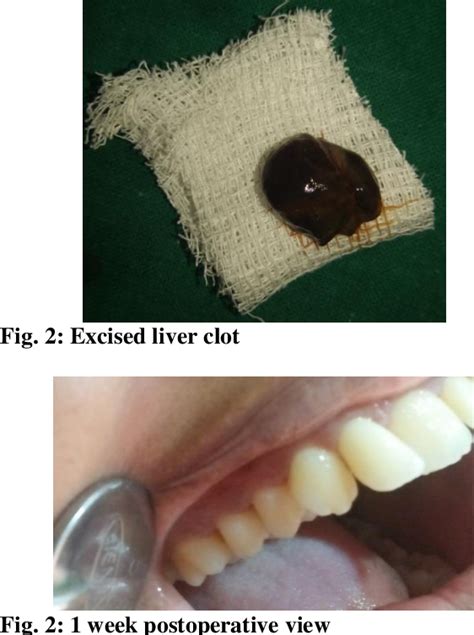 Figure 2 from Liver clot after flap surgery: A case report | Semantic ...