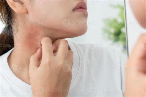 woman scratch body has itchy skin from skin allergic, steroid allergy