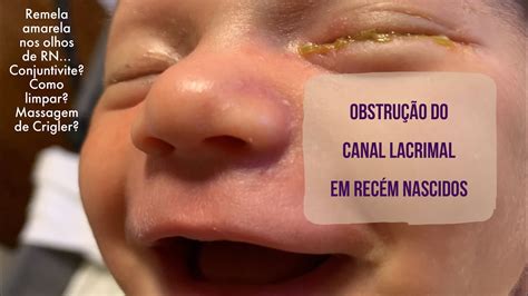 E Normal O Olho Do Recem Nascido Fica Amarelo - Bossa Na Cabeça Do Recem-nascido - RETOEDU