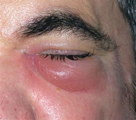cellulitis eye  signs symptoms diagnosis treatment prognosis